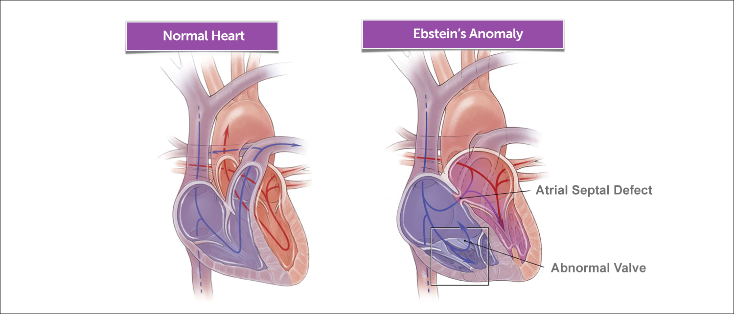 A diagram of a normal heart and a heart with Ebstein's anomaly