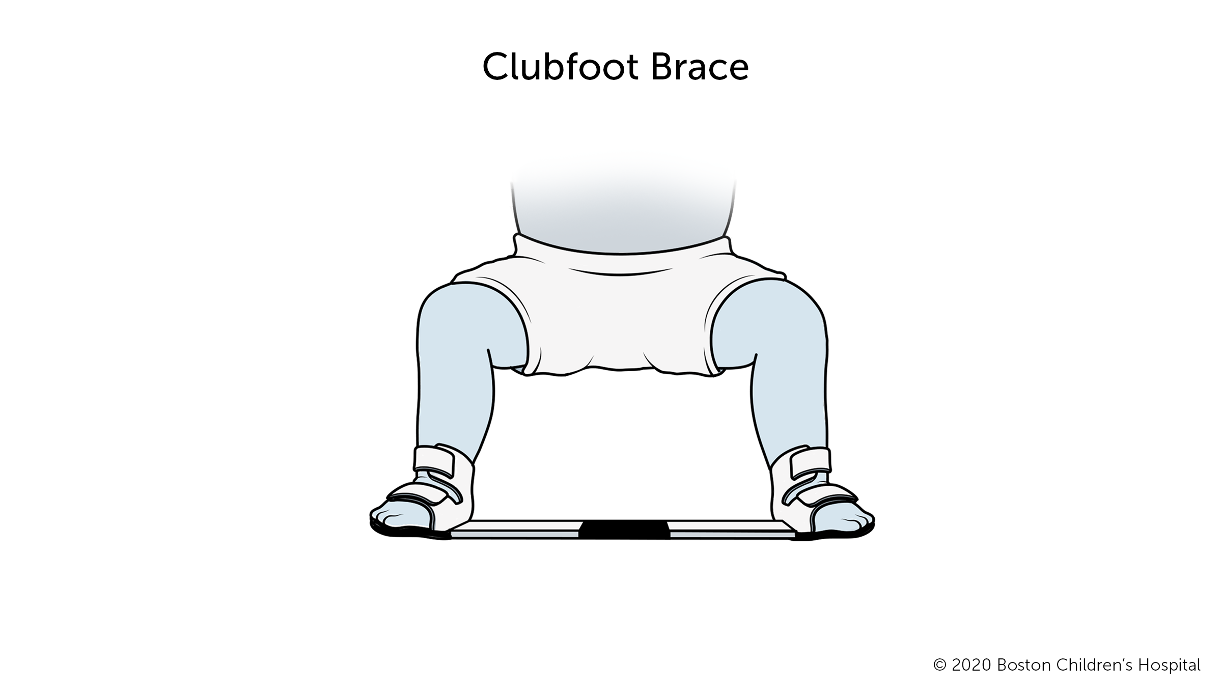 This is how a clubfoot brace works.