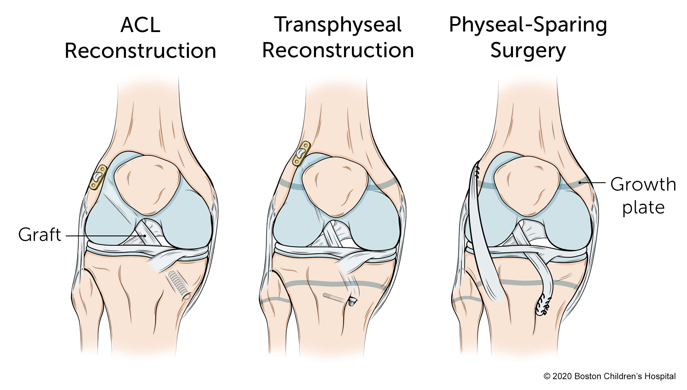 There are three types of surgery available: ACL reconstruction, transphyseal reconstruction, and physeal-sparing surgery.