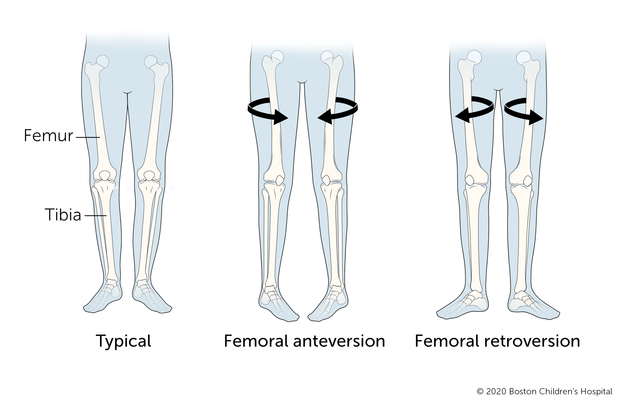 An illustration of typical legs, legs with femoral anteversion, and legs with femoral retroversion.