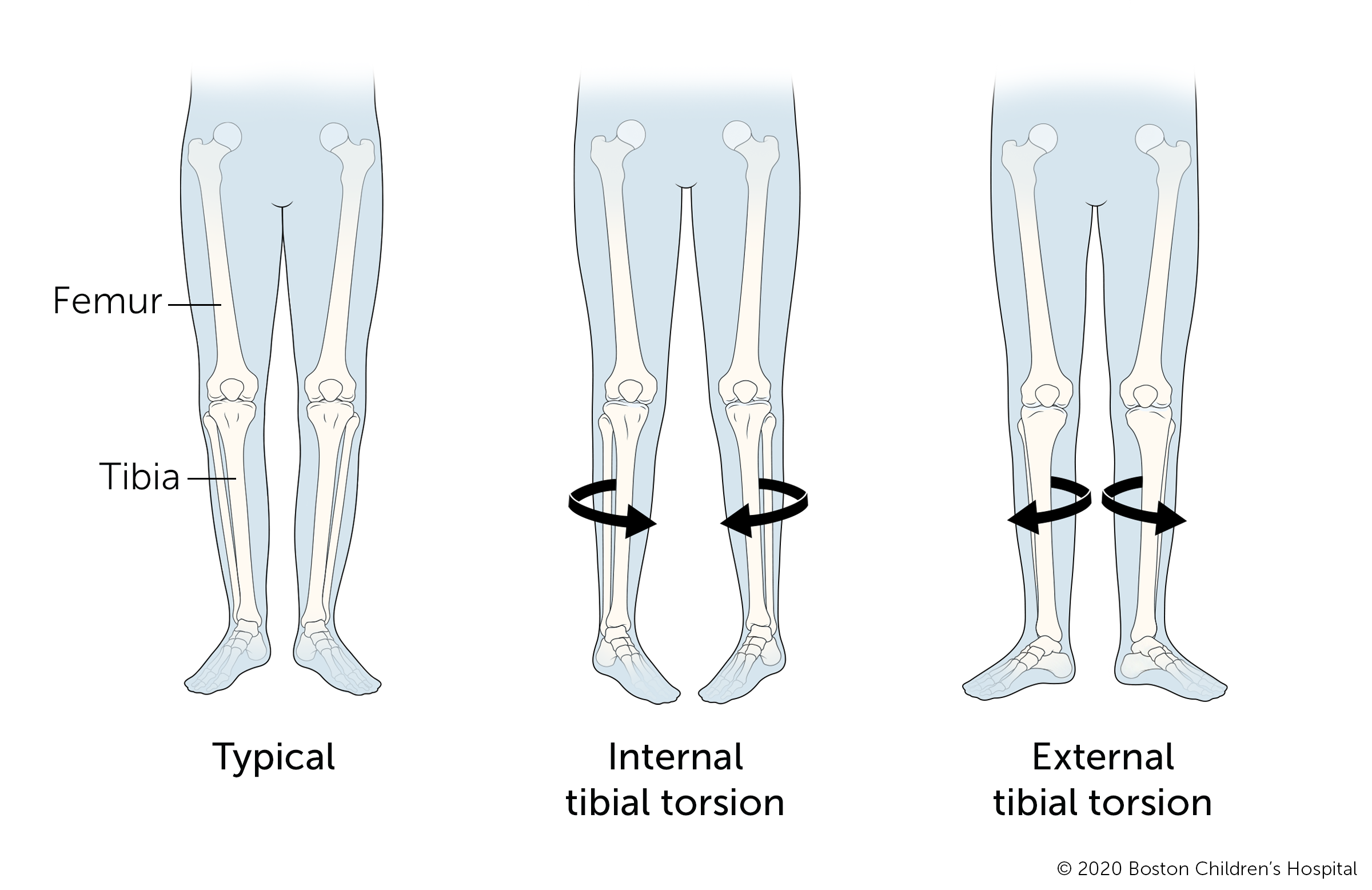 A child with a normal shinbone, a child with internal tibial torsion, and a child with external tibial torsion.