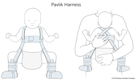 An image of a Pavlik harness