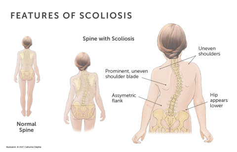 Features of scoliosis