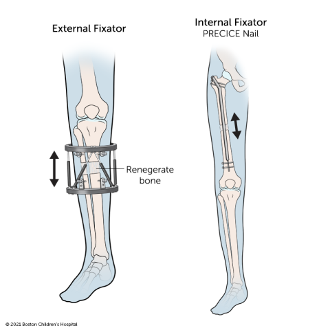 An external fixator stabilizes the bone from the outside of the leg with pins that go into the bone. An internal fixator is inserted into the bone.