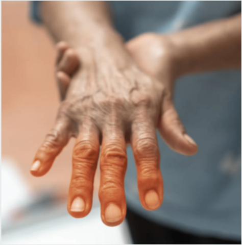 A close up image of a hand with the fingers turning orange which is a symptom of lupus.