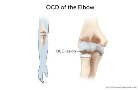 With osteochondritis dissecans of the elbow, a segment of bone in the elbow joint separates from the rest of the bone.