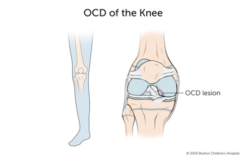 With osteochondritis dissecans of the knee, a segment of bone in the knee joint separates from the rest of the bone.