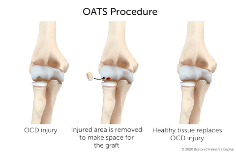 The OATS procedure repairs osteochondritis dissecans by replacing the injured bone and cartilage with healthy tissue taken from elsewhere in the body.